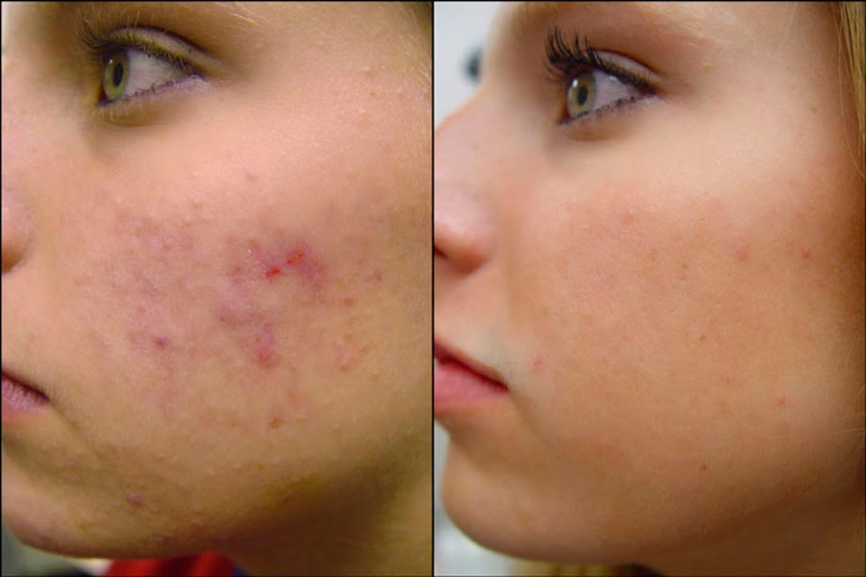 acne_treatment2